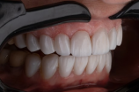 什么是智齿(什么是智齿？该如何正确护理智齿？)
